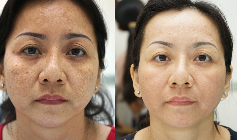 Dầu dừa ngăn ngừa nám da, tàn nhang