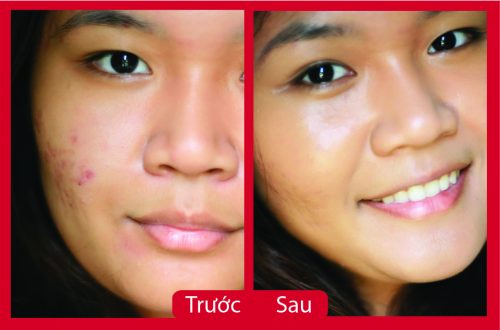 quên nỗi lo với mụn trứng cá với giấm táo mèo