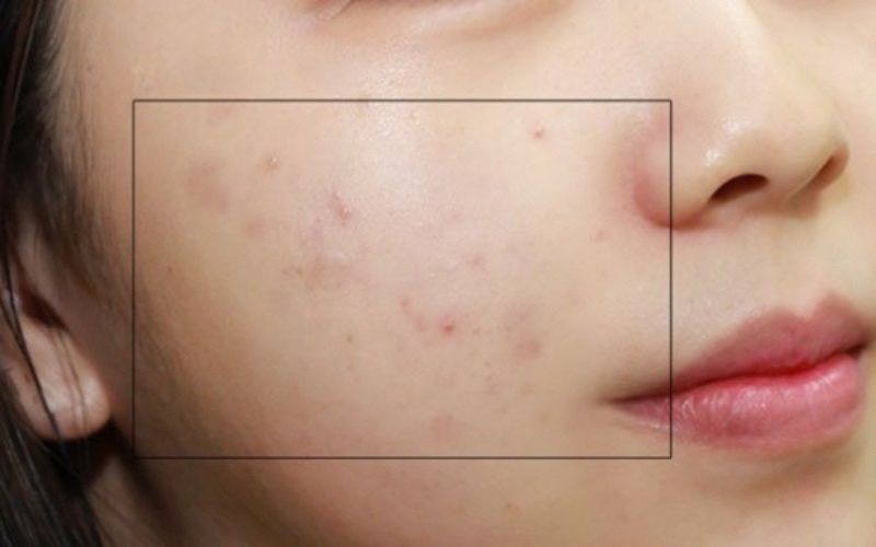 Kiên trì sử dụng mặt nạ dưa leo sẽ làm mờ đi những vệt thâm mới hình thành, thâm nhẹ