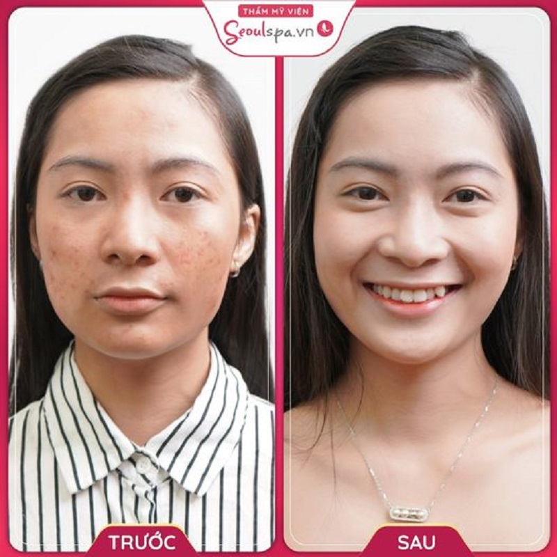 Làn da khách hàng mờ thâm nám và sáng khỏe hơn rất nhiều so với tình trạng da ban đầu sau khi sử dụng dịch vụ vi kim tảo biển