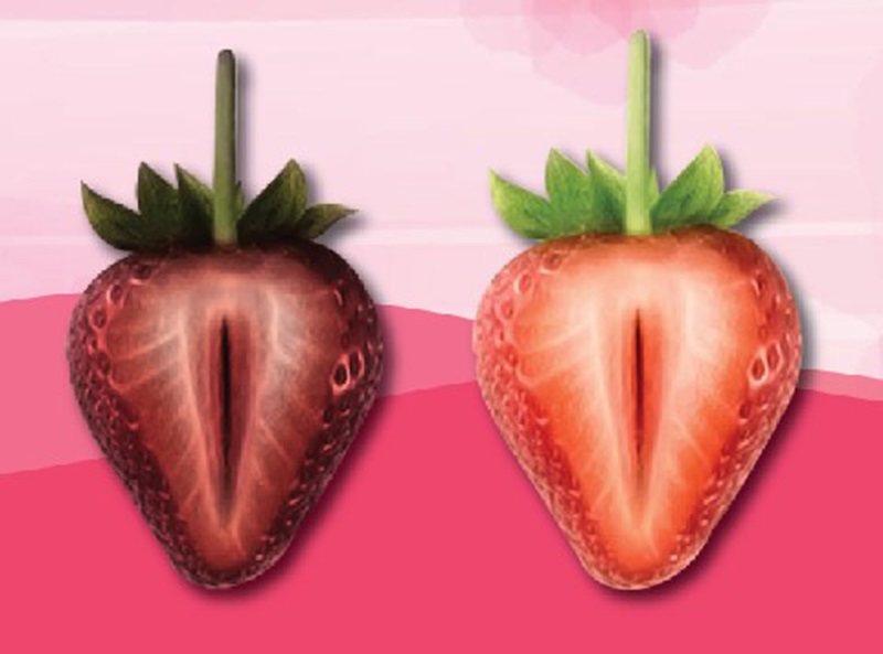 Cô bé thâm đen, xỉn màu kém sắc nhưng chỉ sau liệu trình làm hồng bằng Laser nó đã trở nên tươi tắn và xinh xắn trở lại